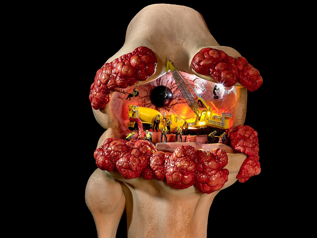 photograph of a model of a knee with miniature models working inside it to remove knee cancer